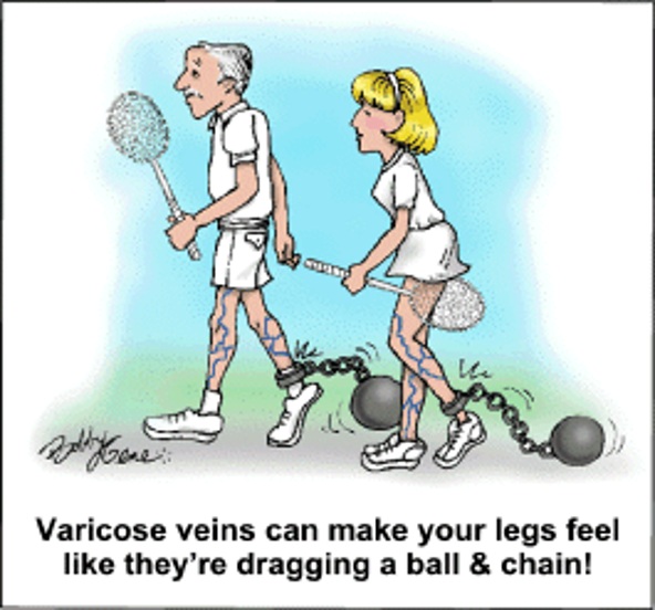 Varicose Veins Symptoms